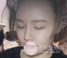 全臉脂肪填充價(jià)格 恢復(fù)過程圖 真實(shí)案例分享