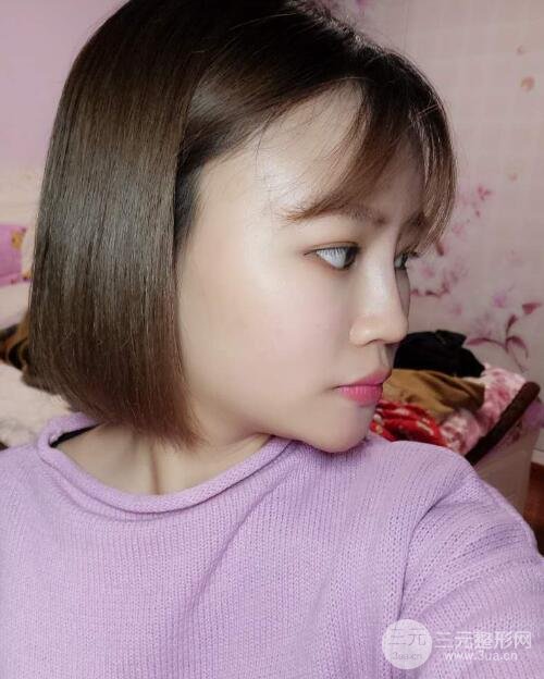 全臉脂肪填充價(jià)格 恢復(fù)過程圖 真實(shí)案例分享