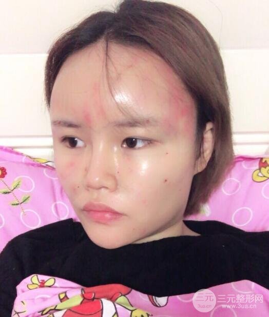 全臉脂肪填充價(jià)格 恢復(fù)過程圖 真實(shí)案例分享