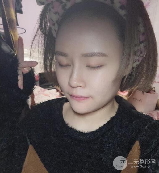 全臉脂肪填充價(jià)格 恢復(fù)過程圖 真實(shí)案例分享