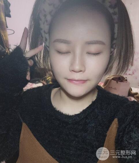 全臉脂肪填充價(jià)格 恢復(fù)過程圖 真實(shí)案例分享