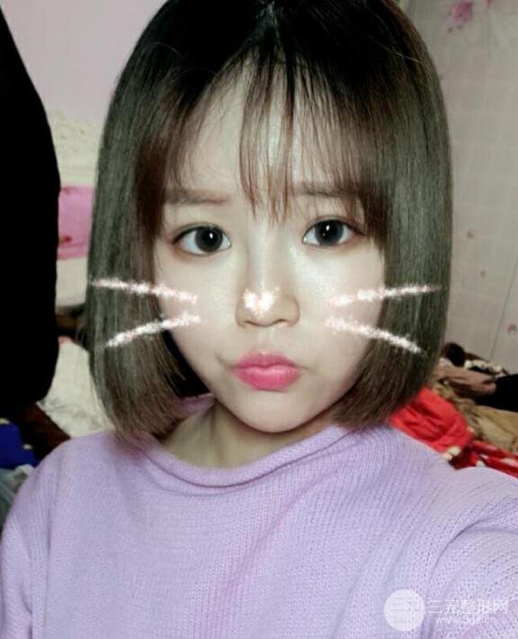 全臉脂肪填充價(jià)格 恢復(fù)過程圖 真實(shí)案例分享