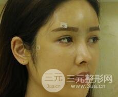 大腿抽脂做臉部脂肪填充 包括太陽(yáng)穴和額頭價(jià)格果分享