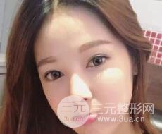 大腿抽脂做臉部脂肪填充 包括太陽(yáng)穴和額頭價(jià)格果分享