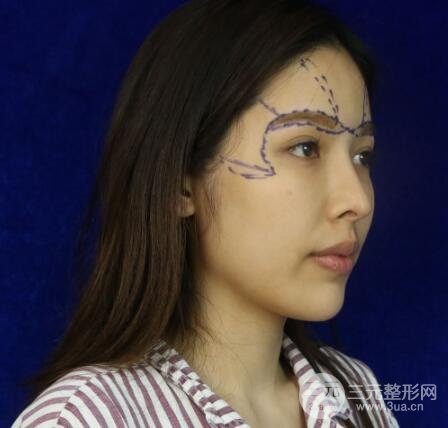 大腿抽脂做臉部脂肪填充 包括太陽穴和額頭價格果分享