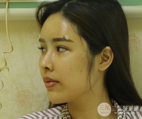 大腿抽脂做臉部脂肪填充 包括太陽穴和額頭價格果分享