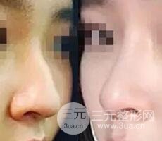 鼻子整形之駝峰鼻矯正價格和前后對比圖 真人案例