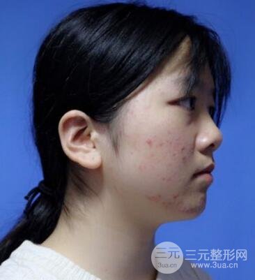 怎樣減掉雙下巴？雙下巴吸脂后個(gè)人經(jīng)歷 價(jià)格略貴但果好