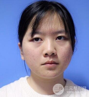 怎樣減掉雙下巴？雙下巴吸脂后個(gè)人經(jīng)歷 價(jià)格略貴但果好