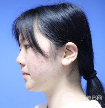 怎樣減掉雙下巴？雙下巴吸脂后個(gè)人經(jīng)歷 價(jià)格略貴但果好