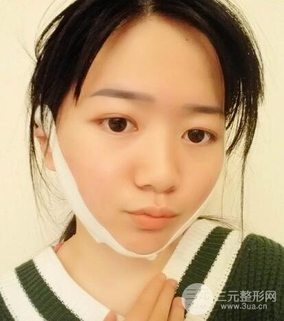 怎樣減掉雙下巴？雙下巴吸脂后個(gè)人經(jīng)歷 價(jià)格略貴但果好