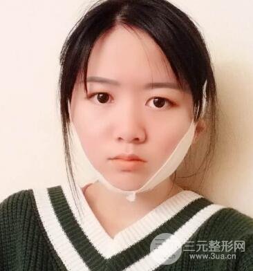 怎樣減掉雙下巴？雙下巴吸脂后個(gè)人經(jīng)歷 價(jià)格略貴但果好