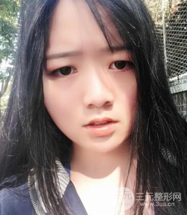 怎樣減掉雙下巴？雙下巴吸脂后個(gè)人經(jīng)歷 價(jià)格略貴但果好