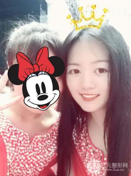 怎樣減掉雙下巴？雙下巴吸脂后個(gè)人經(jīng)歷 價(jià)格略貴但果好