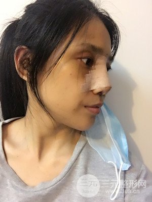 珠海萊茵門診部馬中衛(wèi)隆鼻整形案例分享，并附上前后對比照片~