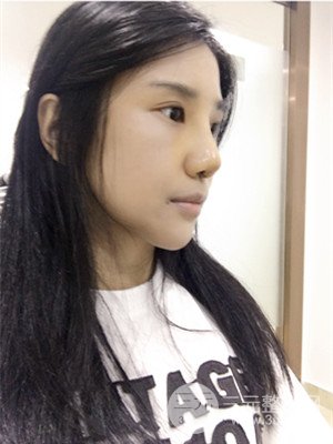 珠海萊茵門診部馬中衛(wèi)隆鼻整形案例分享，并附上前后對比照片~