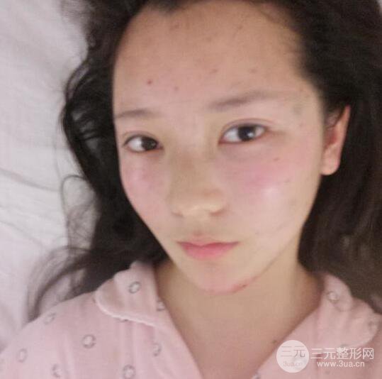 長(zhǎng)得太著急是怎樣一種體驗(yàn)？妹子血淚分享自體脂肪填充詳細(xì)部年輕化經(jīng)驗(yàn)