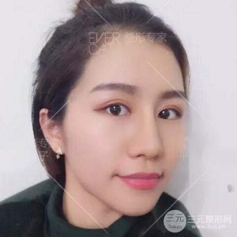 割歐式雙眼皮價格和案例