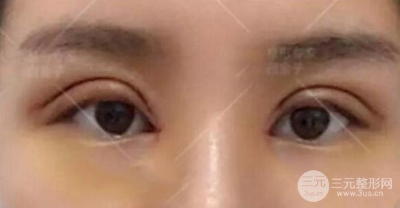 割歐式雙眼皮價格和案例