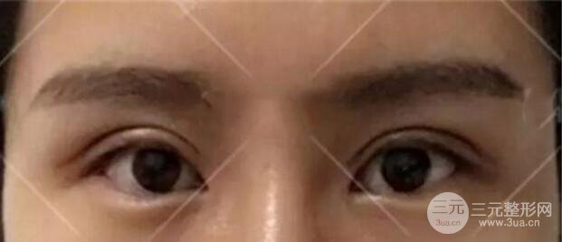 割歐式雙眼皮價格和案例