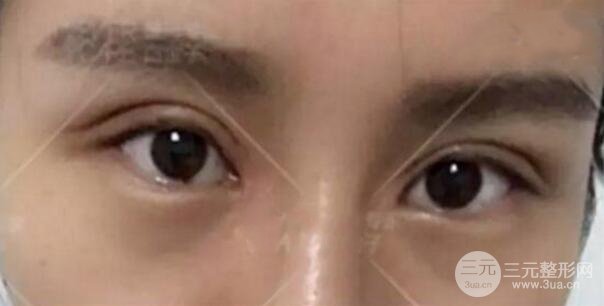 割歐式雙眼皮價格和案例