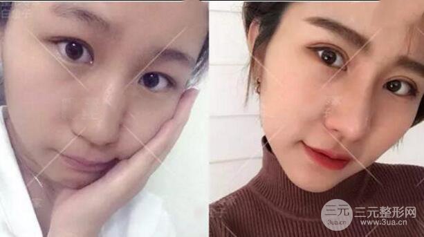 割歐式雙眼皮價格和案例