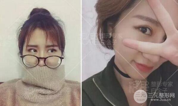 割歐式雙眼皮價格和案例