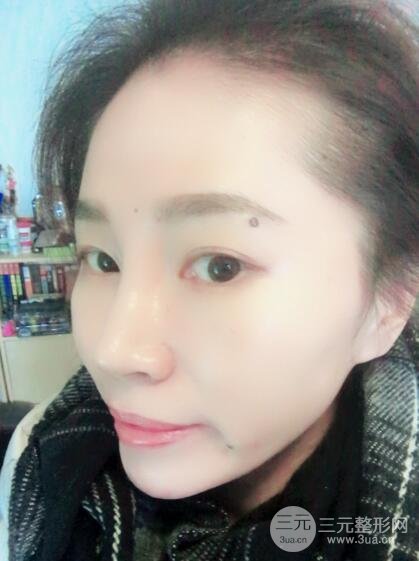 面b提升術(shù)多少錢?價格和案例分享