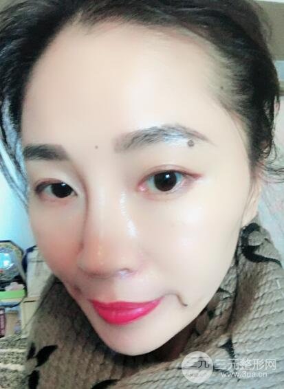 面b提升術(shù)多少錢?價格和案例分享