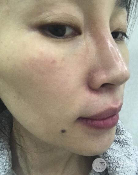 面b提升術(shù)多少錢?價格和案例分享