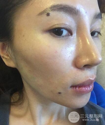 面b提升術(shù)多少錢?價格和案例分享