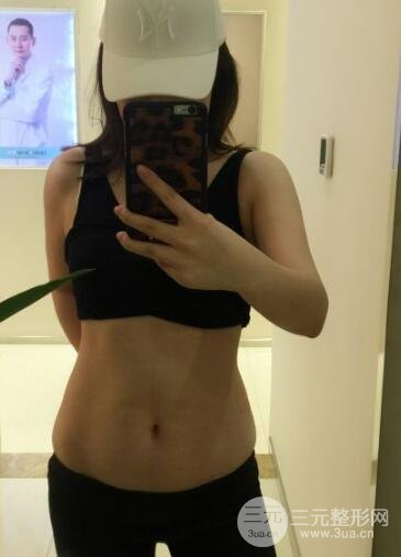 腹部抽脂價格和恢復(fù)案例