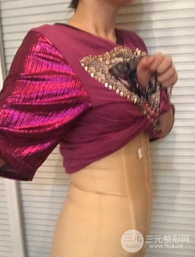 腹部抽脂價格和恢復(fù)案例