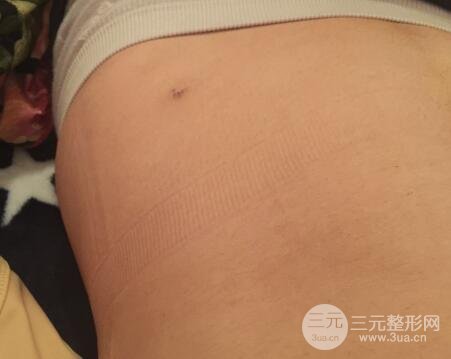 腹部抽脂價格和恢復(fù)案例