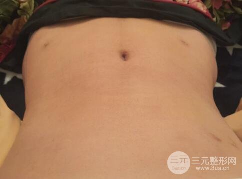 腹部抽脂價格和恢復(fù)案例