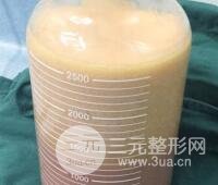 抽脂瘦腿價(jià)格和親身經(jīng)歷圖