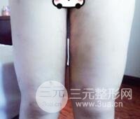 抽脂瘦腿價(jià)格和親身經(jīng)歷圖