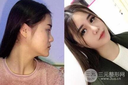 鼻子整形恢復(fù)過程真人案例