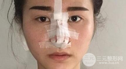 鼻子整形恢復(fù)過程真人案例
