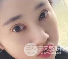 切開雙眼皮+開內(nèi)眼角案例