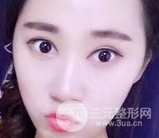 切開雙眼皮+開內(nèi)眼角案例