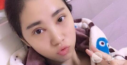 切開雙眼皮+開內(nèi)眼角案例