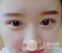 三點(diǎn)定位雙眼皮整形恢復(fù)圖案例