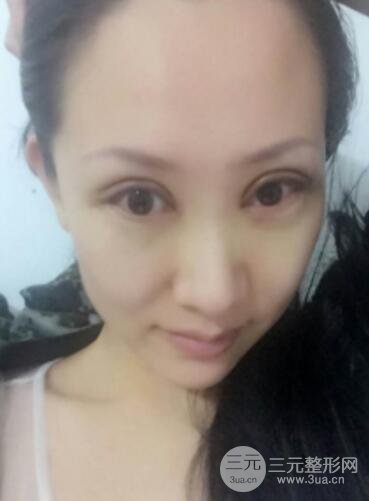 雙眼皮修復(fù)術(shù)價錢和案例圖