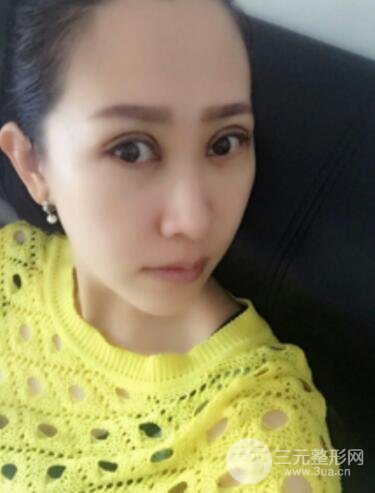 雙眼皮修復(fù)術(shù)價錢和案例圖