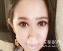 雙眼皮修復(fù)術(shù)價(jià)錢和案例圖