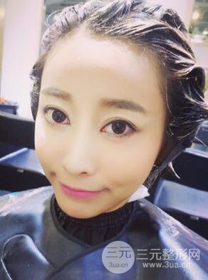 埋埋蛋白線.提升真實案例分享，珠海萊茵門診部馬中衛(wèi)醫(yī)生做的