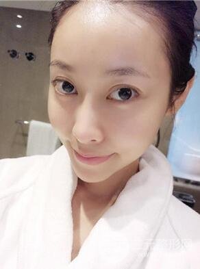 埋埋蛋白線.提升真實案例分享，珠海萊茵門診部馬中衛(wèi)醫(yī)生做的