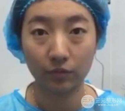 微創(chuàng)內(nèi)切去眼袋手術(shù)價(jià)格和恢復(fù)過(guò)程圖案例