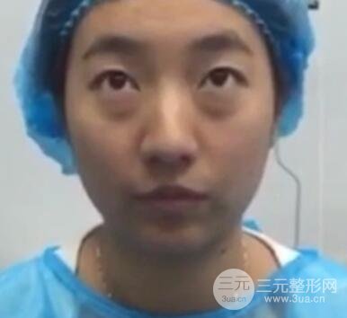 微創(chuàng)內(nèi)切去眼袋手術(shù)價(jià)格和恢復(fù)過(guò)程圖案例